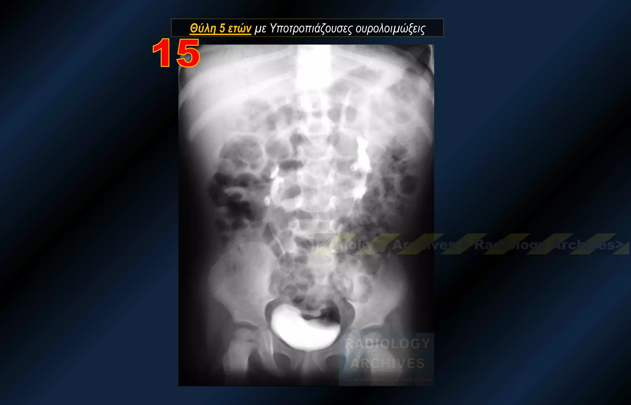 Θύλη 5 ετών με Υποτροπιάζουσες ουρολοιμώξεις  