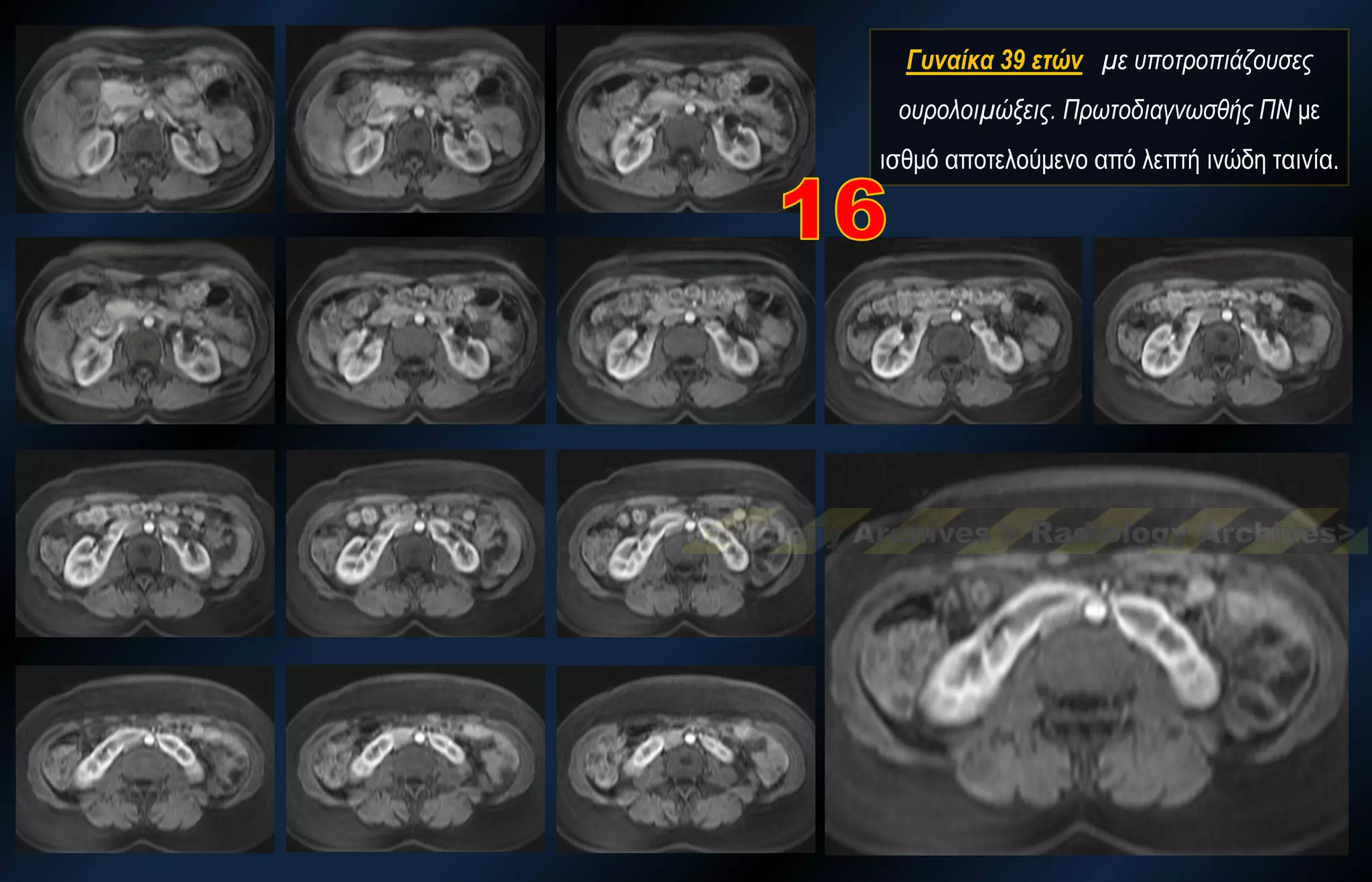 Γυναίκα 39 ετών με υποτροπιάζουσες ουρολοιμώξεις. Πρωτοδιαγνωσθής ΠΝ με ισθμό αποτελούμενο από λεπτή ινώδη ταινία.  