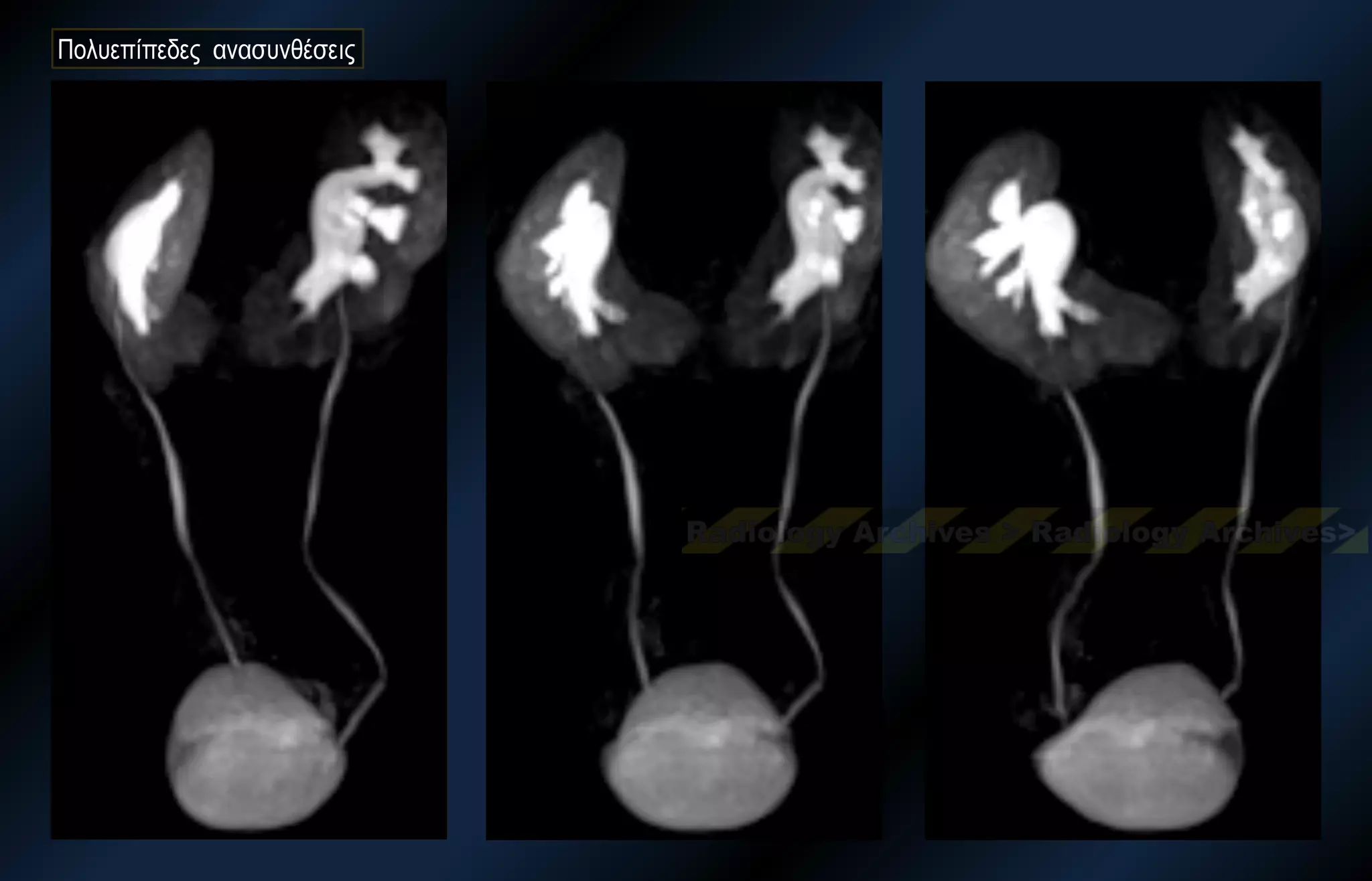 Πολυεπίπεδες ανασυνθέσεις 