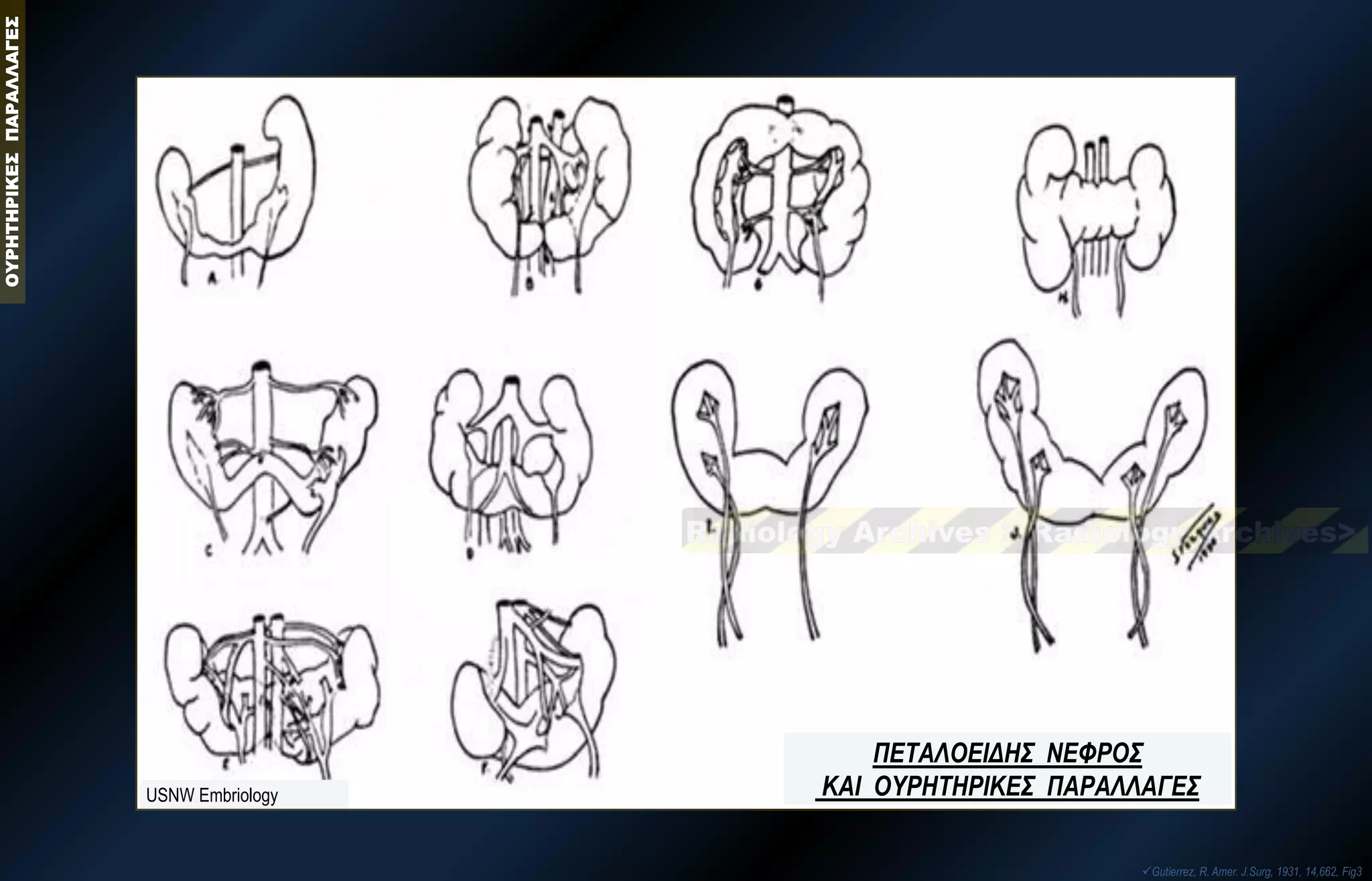 ΟΥΡΗΤΗΡΙΚΕΣ ΠΑΡΑΛΛΑΓΕΣ 
USNW Embriology 
Gutierrez, R. Amer. J.Surg, 1931, 14,662, Fig3 
ΠΕΤΑΛΟΕΙΔΗΣ ΝΕΦΡΟΣ ΚΑΙ ΟΥΡΗΤΗΡΙΚΕΣ ΠΑΡΑΛΛΑΓΕΣ  