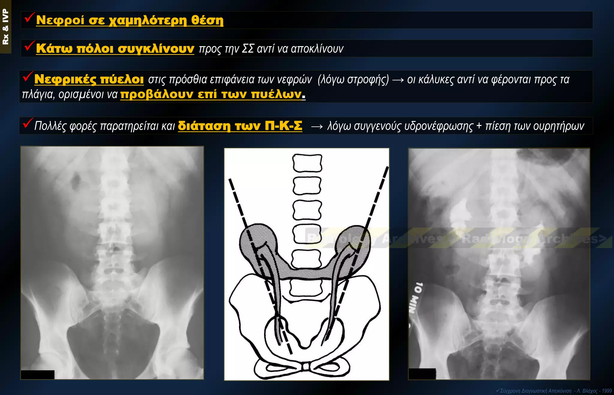 Νεφροί σε χαμηλότερη θέση 
Κάτω πόλοι συγκλίνουν προς την ΣΣ αντί να αποκλίνουν 
Νεφρικές πύελοι στις πρόσθια επιφάνεια των νεφρών (λόγω στροφής) → οι κάλυκες αντί να φέρονται προς τα πλάγια, ορισμένοι να προβάλουν επί των πυέλων. 
Πολλές φορές παρατηρείται και διάταση των Π-Κ-Σ → λόγω συγγενούς υδρονέφρωσης + πίεση των ουρητήρων Rx & IVP 
Σύγχρονη Διαγνωστική Απεικόνιση - Λ. Βλάχος - 1999  