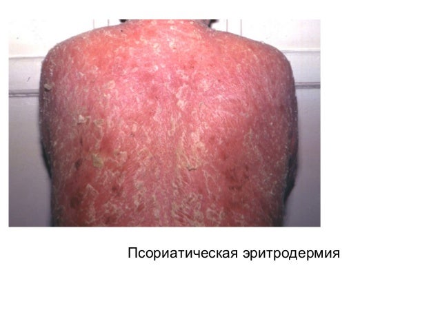 псориаз и парапсориаз