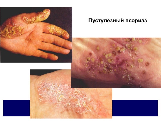 псориаз и парапсориаз