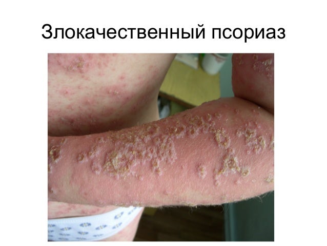 псориаз и парапсориаз