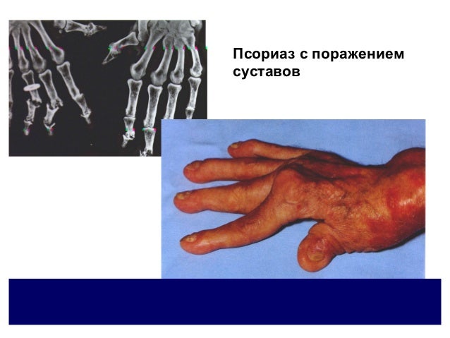 псориаз и парапсориаз