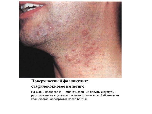 пиодермии