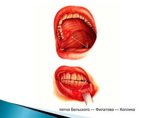 пятна Бельского — Филатова — Коплика 
 