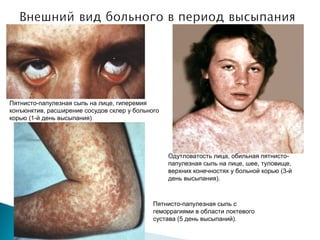 Пятнисто-папулезная сыпь на лице, гиперемия 
конъюнктив, расширение сосудов склер у больного 
корью (1-й день высыпания) 
Одутловатость лица, обильная пятнисто- 
папулезная сыпь на лице, шее, туловище, 
верхних конечностях у больной корью (3-й 
день высыпания). 
Пятнисто-папулезная сыпь с 
геморрагиями в области локтевого 
сустава (5 день высыпаний). 
 