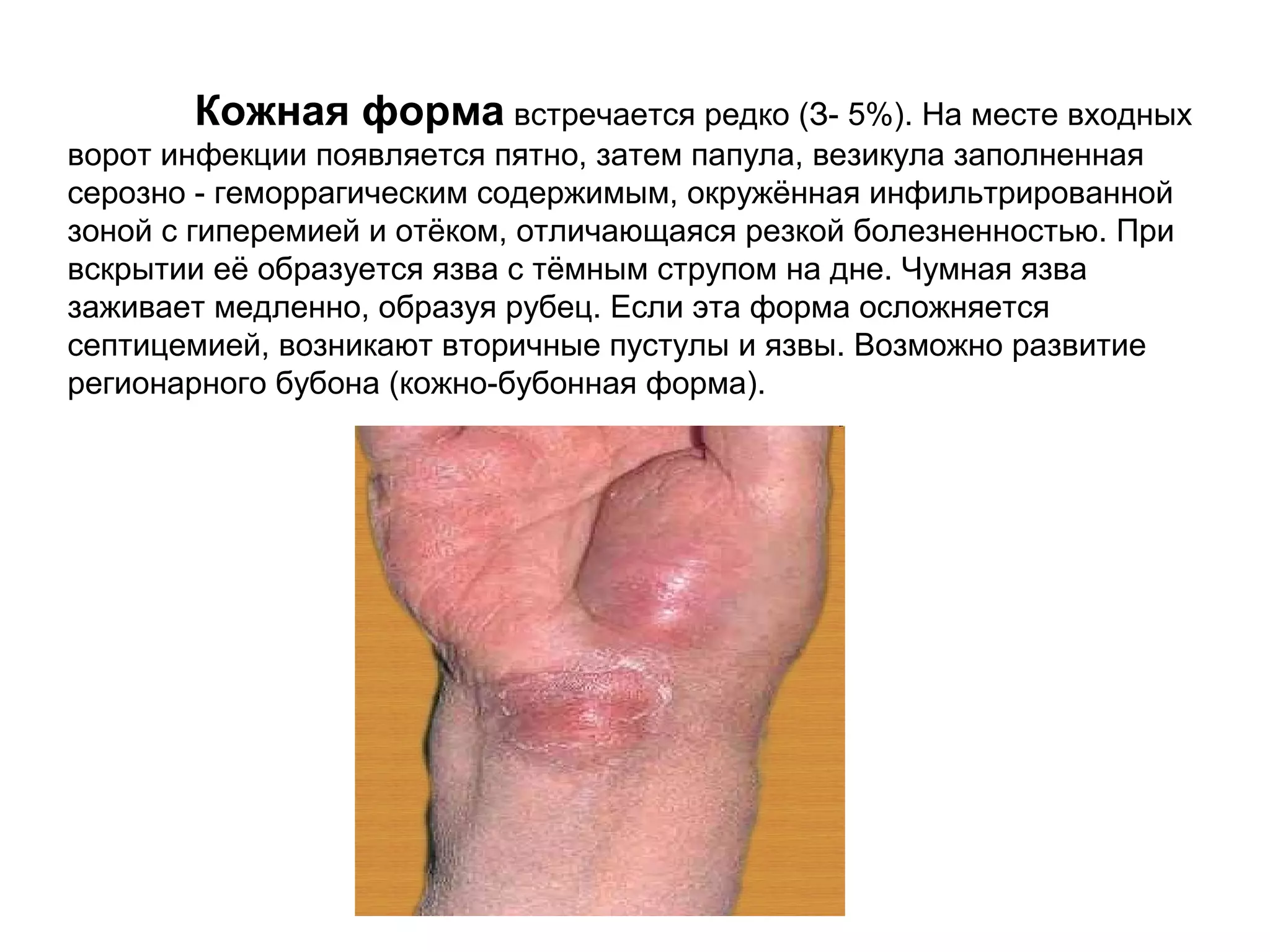 Кожная форма встречается редко (З- 5%). На месте входных 
ворот инфекции появляется пятно, затем папула, везикула заполненная 
серозно - геморрагическим содержимым, окружённая инфильтрированной 
зоной с гиперемией и отёком, отличающаяся резкой болезненностью. При 
вскрытии её образуется язва с тёмным струпом на дне. Чумная язва 
заживает медленно, образуя рубец. Если эта форма осложняется 
септицемией, возникают вторичные пустулы и язвы. Возможно развитие 
регионарного бубона (кожно-бубонная форма). 
 