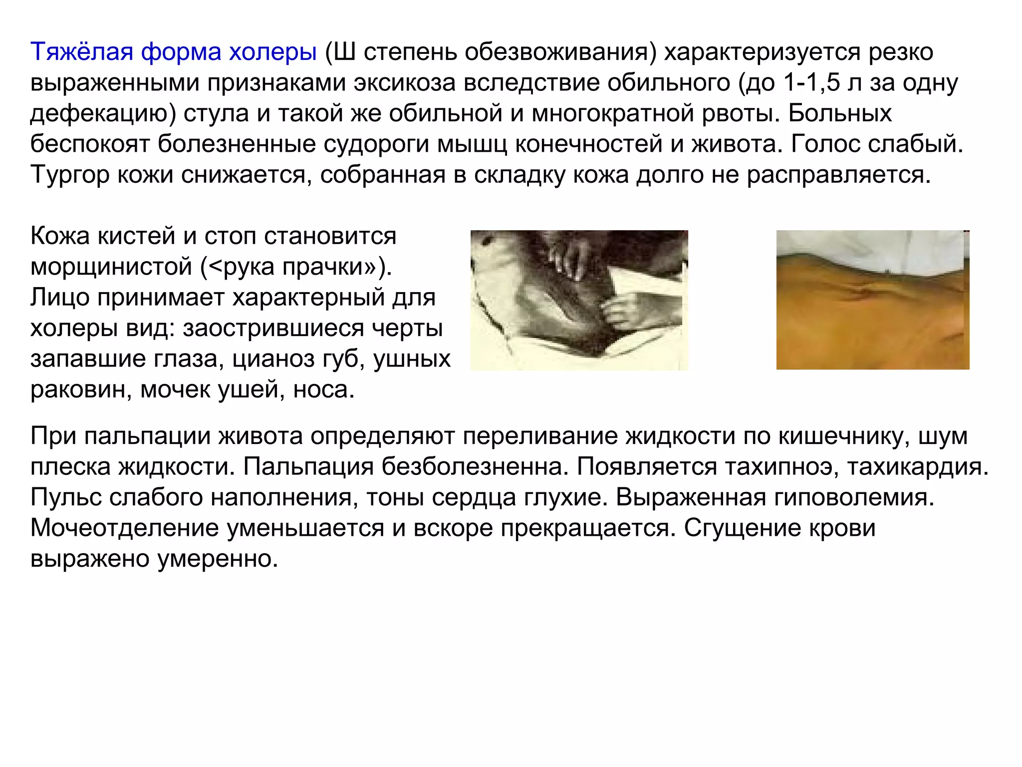 Тяжёлая форма холеры (Ш степень обезвоживания) характеризуется резко 
выраженными признаками эксикоза вследствие обильного (до 1-1,5 л за одну 
дефекацию) стула и такой же обильной и многократной рвоты. Больных 
беспокоят болезненные судороги мышц конечностей и живота. Голос слабый. 
Тургор кожи снижается, собранная в складку кожа долго не расправляется. 
Кожа кистей и стоп становится 
морщинистой (<рука прачки»). 
Лицо принимает характерный для 
холеры вид: заострившиеся черты 
запавшие глаза, цианоз губ, ушных 
раковин, мочек ушей, носа. 
При пальпации живота определяют переливание жидкости по кишечнику, шум 
плеска жидкости. Пальпация безболезненна. Появляется тахипноэ, тахикардия. 
Пульс слабого наполнения, тоны сердца глухие. Выраженная гиповолемия. 
Мочеотделение уменьшается и вскоре прекращается. Сгущение крови 
выражено умеренно. 
 