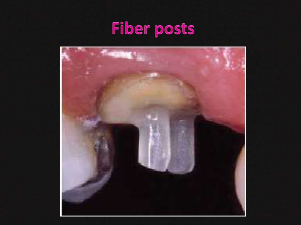 dental post and core
