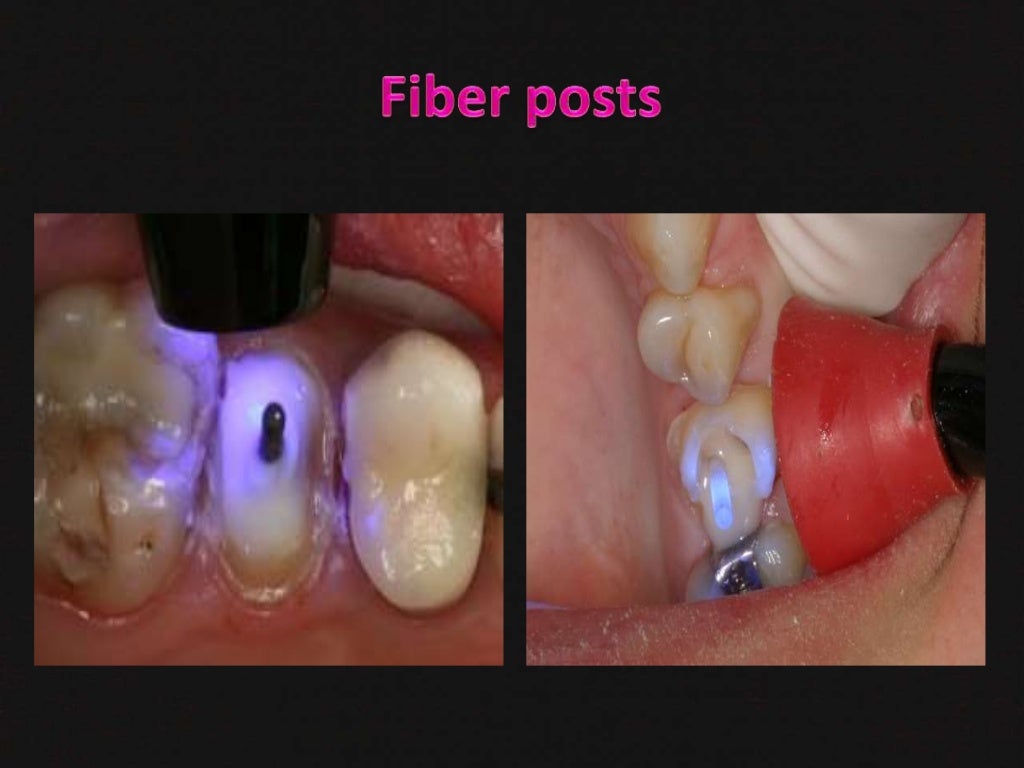 dental post and core