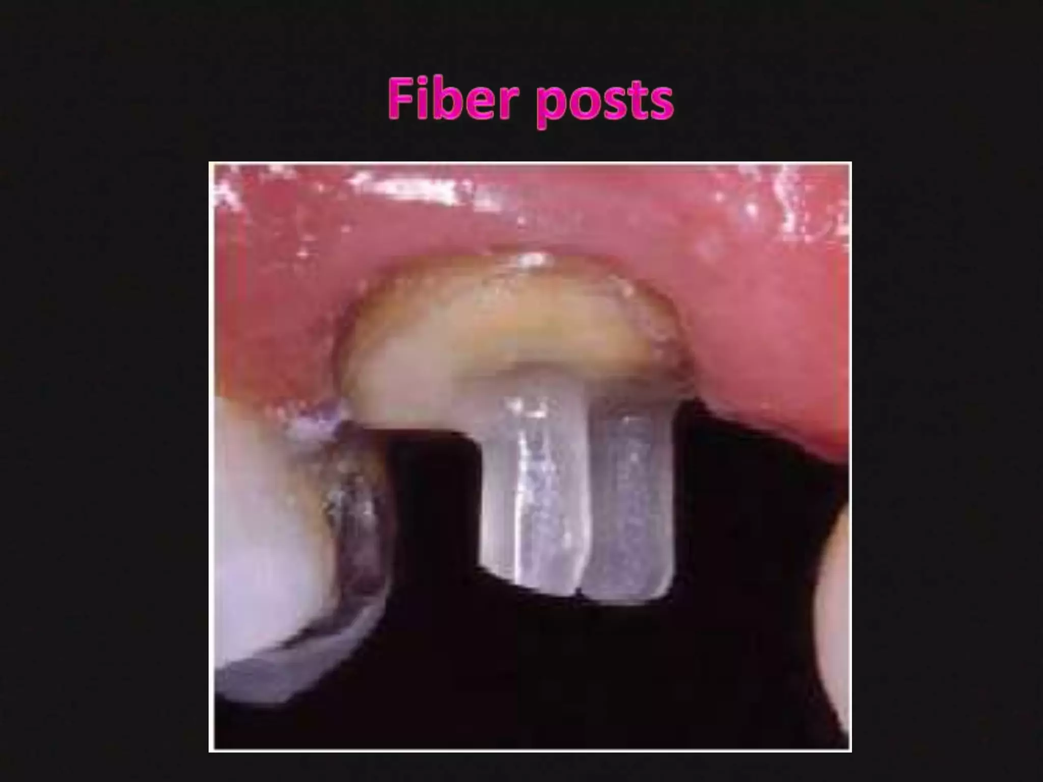 dental post and core | PPT