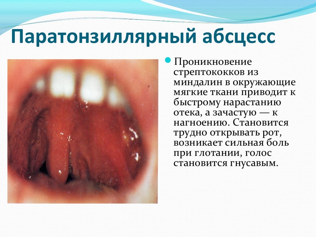 ангины