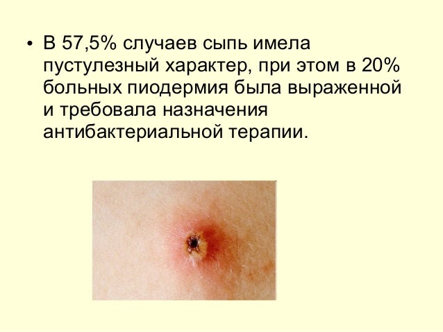ветряная оспа