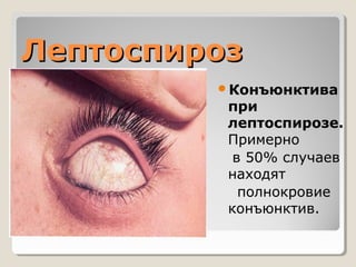 ЛЛееппттооссппиирроозз 
Конъюнктива 
при 
лептоспирозе. 
Примерно 
в 50% случаев 
находят 
полнокровие 
конъюнктив. 
 