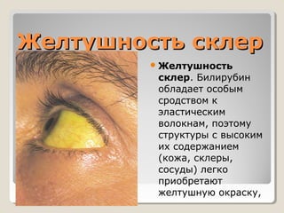 ЖЖееллттуушшннооссттьь ссккллеерр 
Желтушность 
склер. Билирубин 
обладает особым 
сродством к 
эластическим 
волокнам, поэтому 
структуры с высоким 
их содержанием 
(кожа, склеры, 
сосуды) легко 
приобретают 
желтушную окраску, 
 
