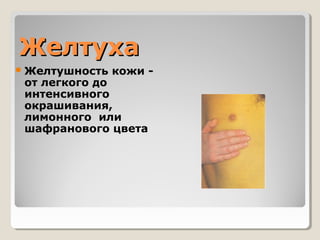 ЖЖееллттууххаа 
Желтушность кожи - 
от легкого до 
интенсивного 
окрашивания, 
лимонного или 
шафранового цвета 
 