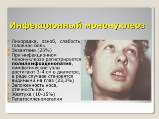 ИИннффееккццииоонннныыйй ммооннооннууккллееоозз 
 Лихорадка, озноб, слабость, 
головная боль 
 Экзантема (25%) 
 При инфекционном 
мононуклеозе регистрируется 
полилимфоаденопатия, 
лимфатические узлы 
достигают 3-4 см в диаметре, 
в ряде случаев становятся 
видимыми на глаз (23,3%) 
 Заложенность носа, 
отечность век 
 Желтуха (10-15%) 
 Гепатоспленомегалия 
 