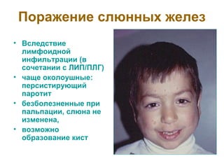 Поражение слюнных желез 
• Вследствие 
лимфоидной 
инфильтрации (в 
сочетании с ЛИП/ПЛГ) 
• чаще околоушные: 
персистирующий 
паротит 
• безболезненные при 
пальпации, слюна не 
изменена, 
• возможно 
образование кист 
 