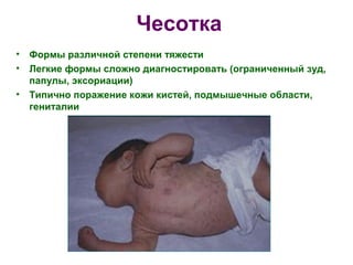 Чесотка 
• Формы различной степени тяжести 
• Легкие формы сложно диагностировать (ограниченный зуд, 
папулы, эксориации) 
• Типично поражение кожи кистей, подмышечные области, 
гениталии 
 