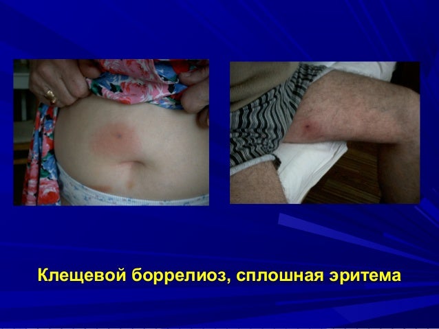 клещевой боррелиоз