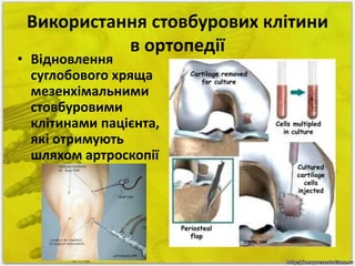 Використання стовбурових клітини 
в ортопедії 
• Відновлення 
суглобового хряща 
мезенхімальними 
стовбуровими 
клітинами пацієнта, 
які отримують 
шляхом артроскопії 
 