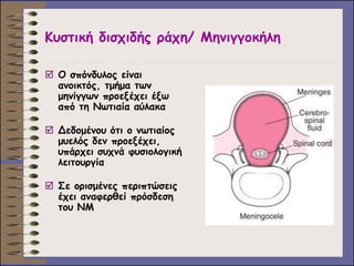 Κυστική δισχιδής ράχη/ Μηνιγγοκήλη 
Ο σπόνδυλος είναι ανοικτός, τμήμα των μηνίγγων προεξέχει έξω από τη Νωτιαία αύλακα 
Δεδομένου ότι ο νωτιαίος μυελός δεν προεξέχει, υπάρχει συχνά φυσιολογική λειτουργία 
Σε ορισμένες περιπτώσεις έχει αναφερθεί πρόσδεση του ΝΜ 
 