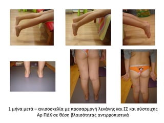 1 μήνα μετά – ανισοσκελία με προσαρμογή λεκάνης και ΣΣ και σύστοιχης
Αρ ΠΔΚ σε θέση βλαισότητας αντιρροπιστικά
 