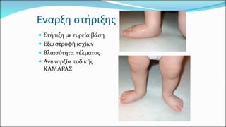 Στήριξη με ευρεία βάση 
Εξω στροφή ισχίων 
Βλαισότητα πέλματος 
Ανυπαρξία ποδικής ΚΑΜΑΡΑΣ 
Εναρξη στήριξης  