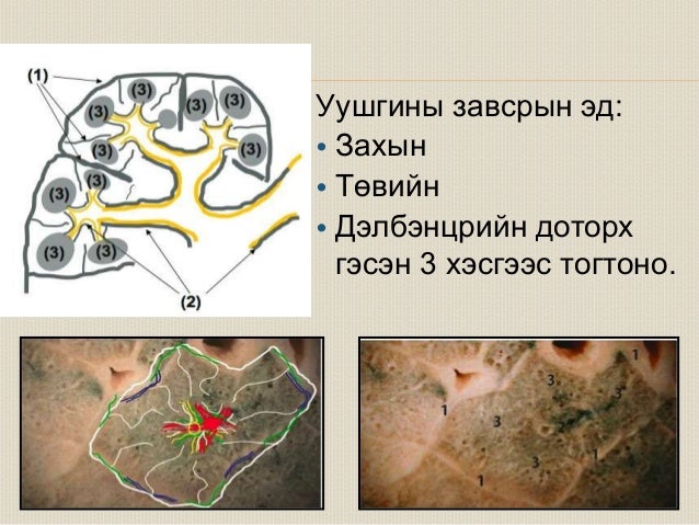 уушигны завсрын эдийн өвчнүүд