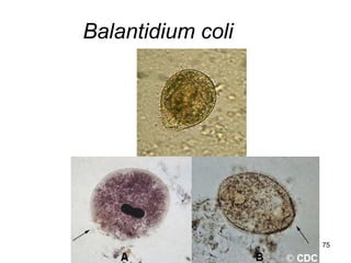 75 
Balantidium coli  