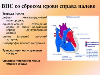 ВПС со сбросом крови справа налево 
Тетрада Фалло 
дефект межжелудочковой 
перегородки; 
одновременное отхождение 
аорты от обоих желудочков 
сердца (декстрапозиция 
аорты); 
стеноз (атрезия) легочной 
артерии; 
гипертрофия правого желудочка 
Транспозиция магистральных 
сосудов 
Синдром гипоплазии левых 
отделов сердца 
 