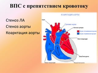 ВПС с препятствием кровотоку 
Стеноз ЛА 
Стеноз аорты 
Коарктация аорты 
 