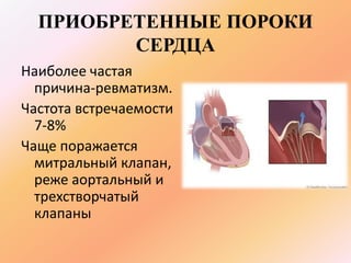 ПРИОБРЕТЕННЫЕ ПОРОКИ 
СЕРДЦА 
Наиболее частая 
причина-ревматизм. 
Частота встречаемости 
7-8% 
Чаще поражается 
митральный клапан, 
реже аортальный и 
трехстворчатый 
клапаны 
 