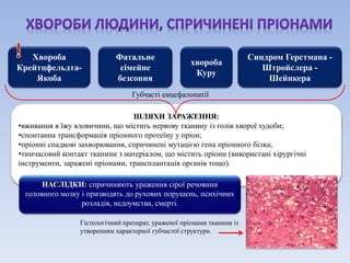 Хвороба 
Крейтцфельдта- 
Якоба 
Фатальне 
сімейне 
безсоння 
хвороба 
Куру 
Синдром Герстмана - 
Штройслера - 
Шейнкера 
Губчасті енцефалопатії 
ШЛЯХИ ЗАРАЖЕННЯ: 
•вживання в їжу яловичини, що містить нервову тканину із голів хворої худоби; 
•спонтанна трансформація пріонного протеїну у пріон; 
•пріонні спадкові захворювання, спричинені мутацією гена пріонного білка; 
•тимчасовий контакт тканини з матеріалом, що містить пріони (використані хірургічні 
інструменти, заражені пріонами, трансплантація органів тощо). 
НАСЛІДКИ: спричиняють ураження сірої речовини 
головного мозку і призводять до рухових порушень, психічних 
розладів, недоумства, смерті. 
Гістологічний препарат, ураженої пріонами тканини із 
утворенням характерної губчастої структури. 
 