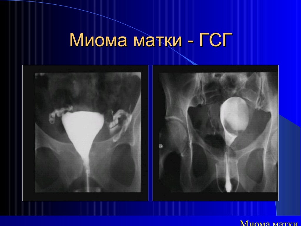 миома матки