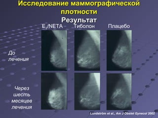 м Исследование мааммммооггррааффииччеессккоойй 
E2/NETA Тиболон Плацебо 
До 
лечения 
Через 
шесть 
месяцев 
лечения 
ппллооттннооссттии 
РРееззууллььттаатт 
Lundström et al., Am J Obstet Gynecol 2002 
 