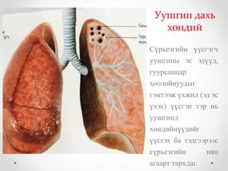 Уушгин дахь 
хөндий 
Сүрьеэгийн үүсгэгч 
уушгины эс эдүүд, 
гуурсанцар 
хоолойнуудыг 
гэмтээж үхжил (эд эс 
үхэх) үүсгэн тэр нь 
уушгинд 
хөндийнүүдийг 
үүсгэх ба тэдгээрээс 
сүрьеэгийн нян 
агаарт тархдаг. 
 