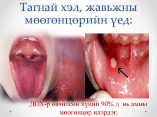 Тагнай хэл, жавьжны 
мөөгөнцөрийн үед: 
ДОХ-р өвчилсөн хүний 90% д нь амны 
мөөгөнцөр илэрдэг. 
 
