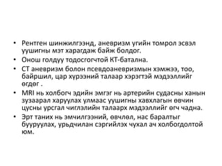 уушигны артерийн аневризм | PPT