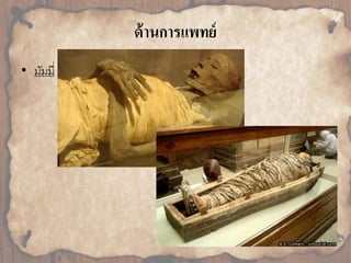 ด้านการแพทย์ 
• มัมมี่ 
 
