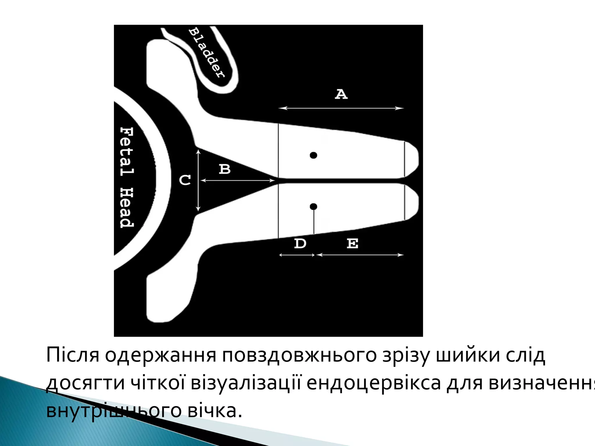 Після одержання повздовжнього зрізу шийки слід 
досягти чіткої візуалізації ендоцервікса для визначення 
внутрішнього вічка. 
 