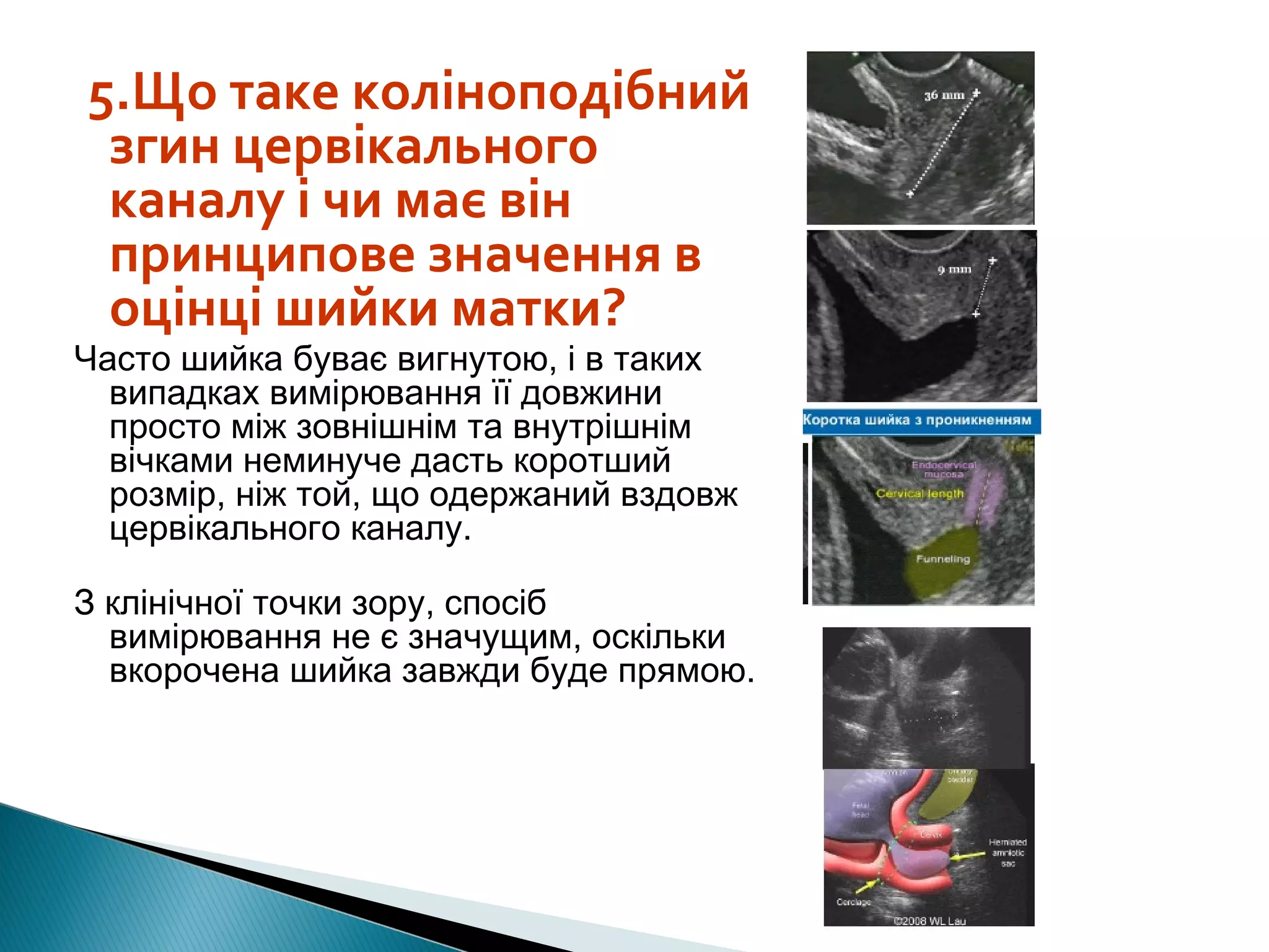 5.Що таке коліноподібний 
згин цервікального 
каналу і чи має він 
принципове значення в 
оцінці шийки матки? 
Часто шийка буває вигнутою, і в таких 
випадках вимірювання її довжини 
просто між зовнішнім та внутрішнім 
вічками неминуче дасть коротший 
розмір, ніж той, що одержаний вздовж 
цервікального каналу. 
З клінічної точки зору, спосіб 
вимірювання не є значущим, оскільки 
вкорочена шийка завжди буде прямою. 
 