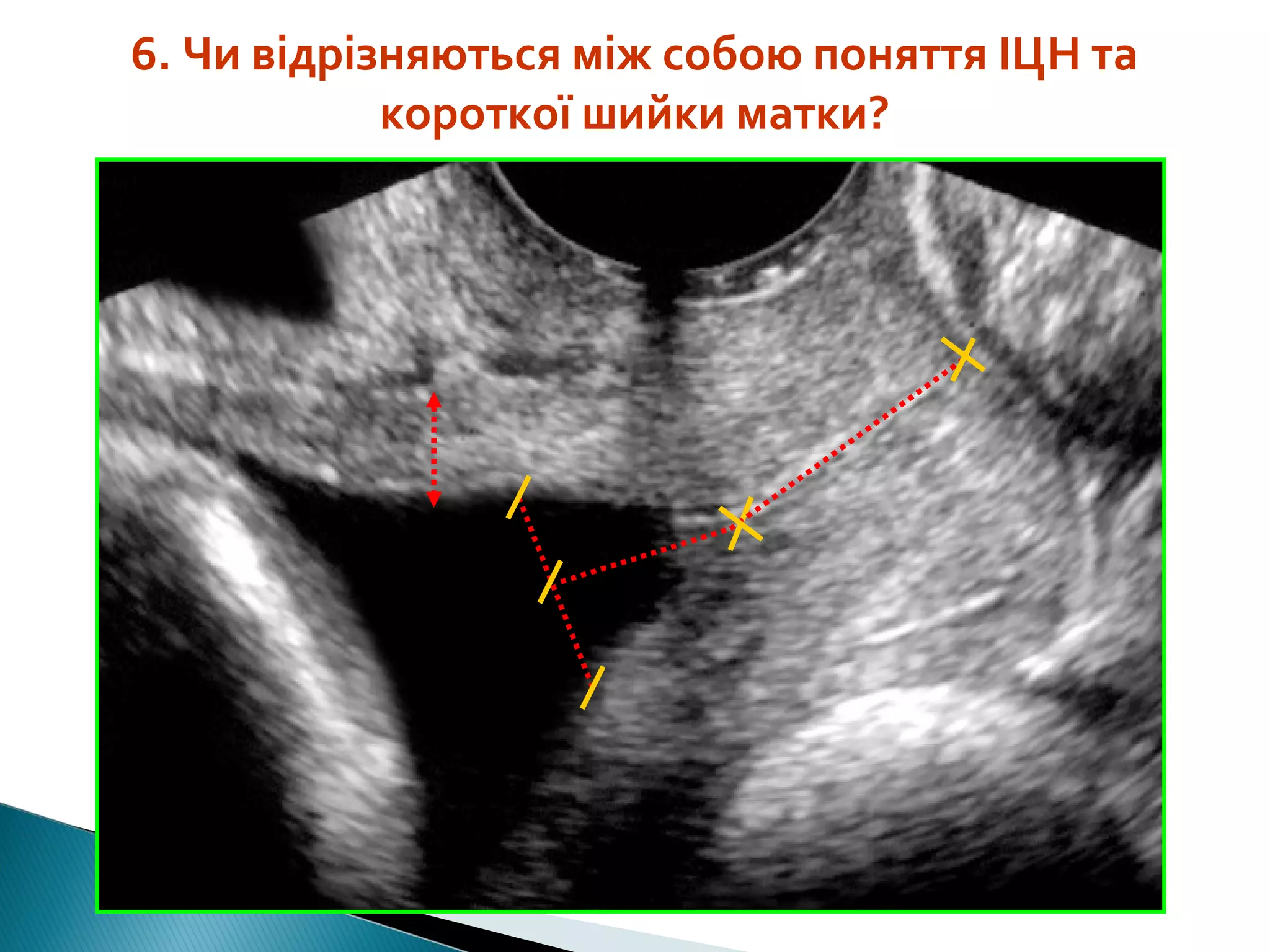 6. Чи відрізняються між собою поняття ІЦН та 
короткої шийки матки? 
 