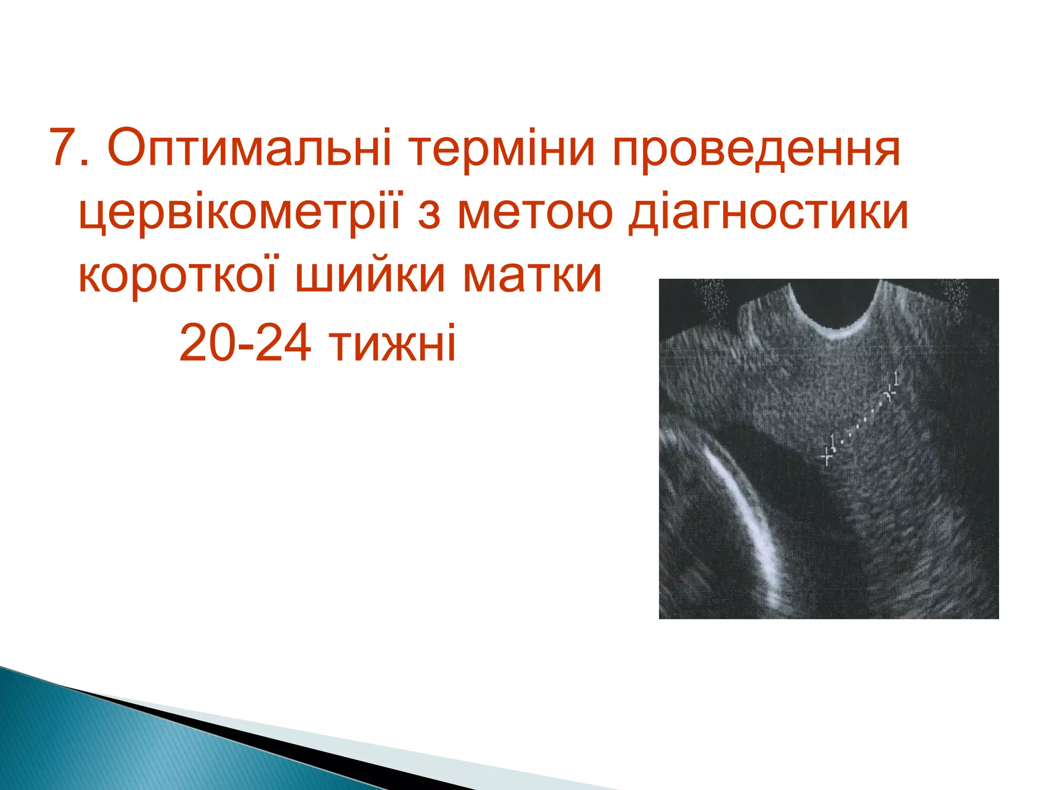 7. Оптимальні терміни проведення 
цервікометрії з метою діагностики 
короткої шийки матки 
20-24 тижні 
 