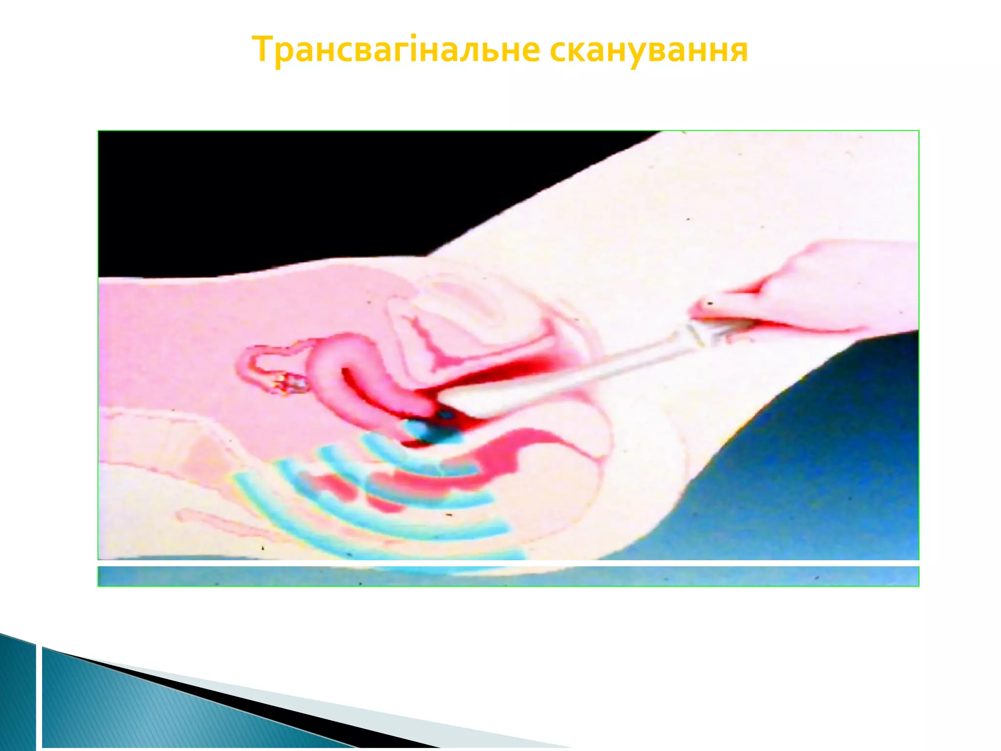 Трансвагінальне сканування 
 