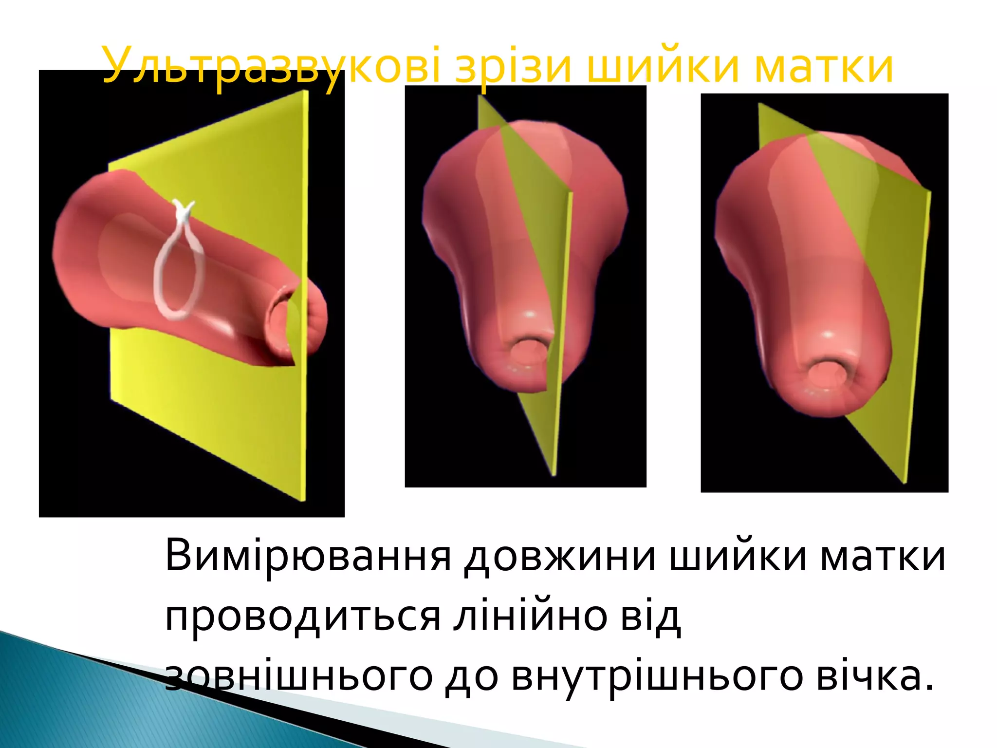 Ультразвукові зрізи шийки матки 
Вимірювання довжини шийки матки 
проводиться лінійно від 
зовнішнього до внутрішнього вічка. 
 