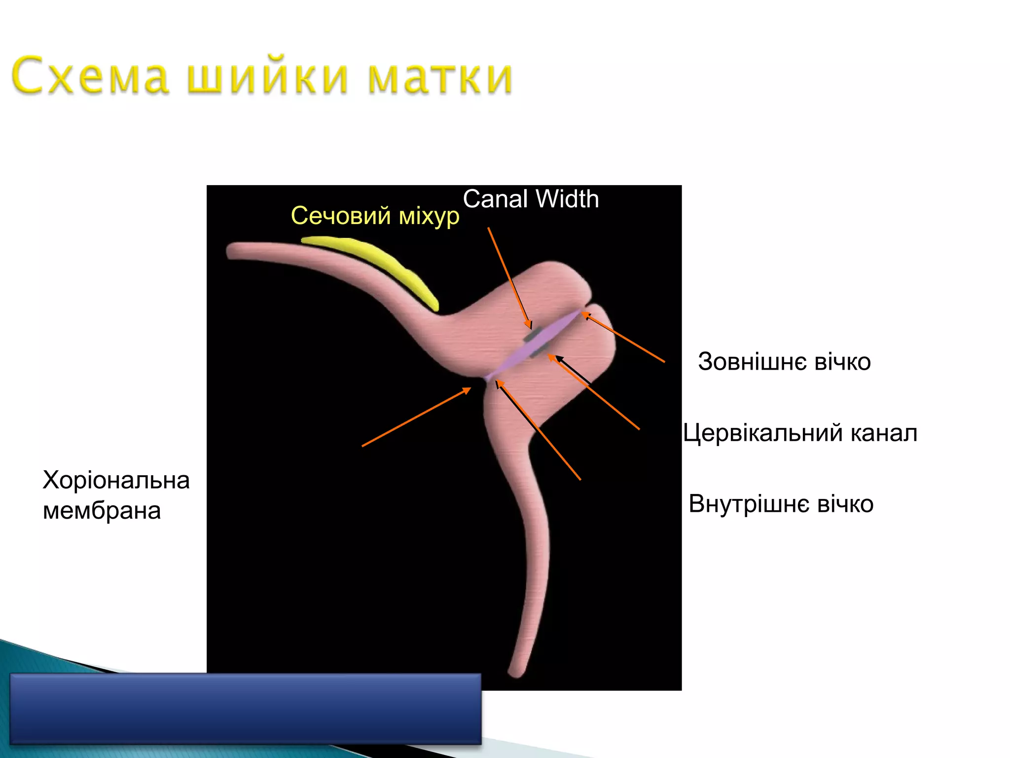 Зовнішнє вічко 
Цервікальний канал 
Canal Width 
Внутрішнє вічко 
Сечовий міхур 
Хоріональна 
мембрана 
 