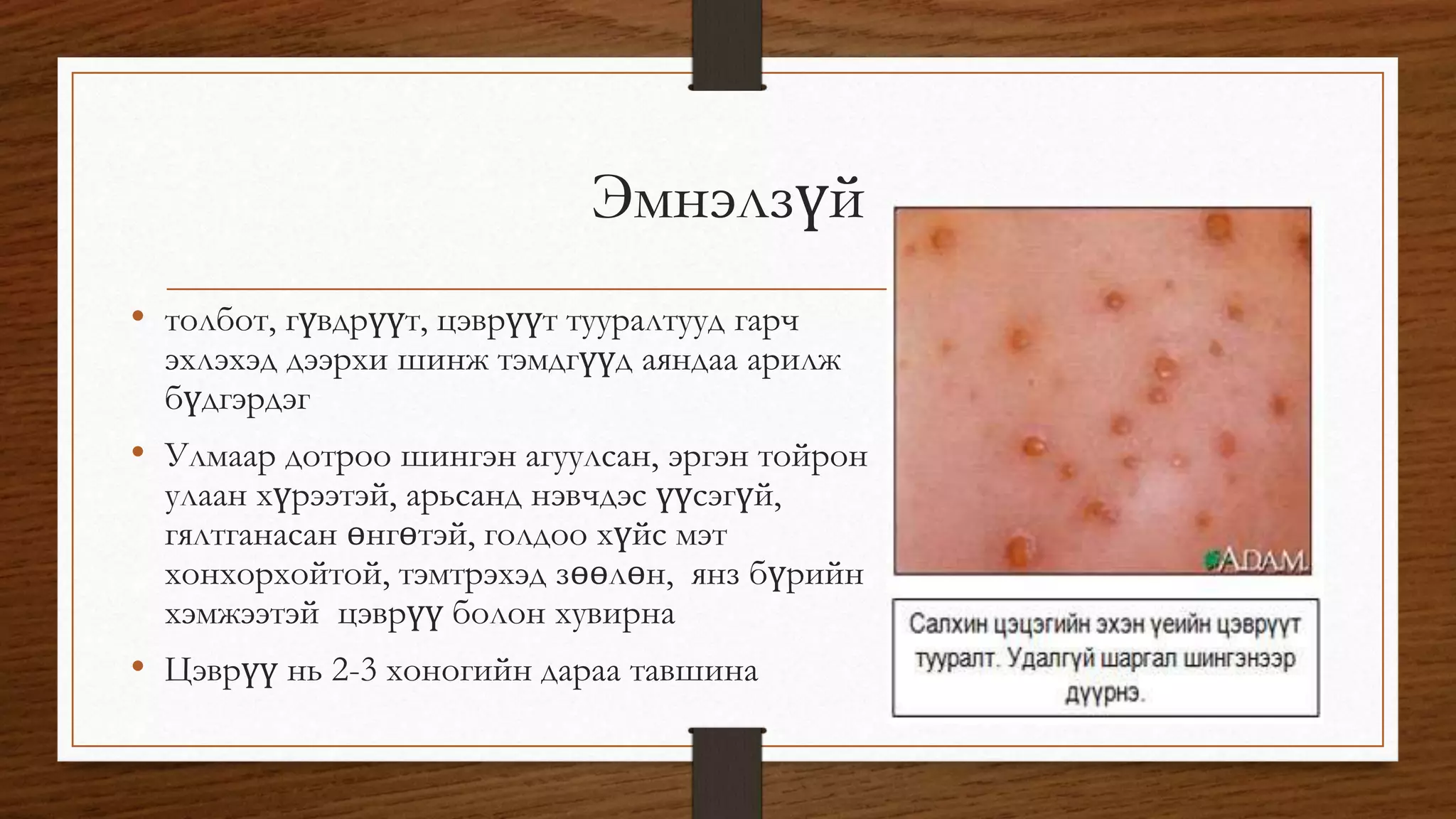 Эмнэлзүй 
• толбот, гүвдрүүт, цэврүүт тууралтууд гарч 
эхлэхэд дээрхи шинж тэмдгүүд аяндаа арилж 
бүдгэрдэг 
• Улмаар дотроо шингэн агуулсан, эргэн тойрон 
улаан хүрээтэй, арьсанд нэвчдэс үүсэгүй, 
гялтганасан өнгөтэй, голдоо хүйс мэт 
хонхорхойтой, тэмтрэхэд зөөлөн, янз бүрийн 
хэмжээтэй цэврүү болон хувирна 
• Цэврүү нь 2-3 хоногийн дараа тавшина 
 